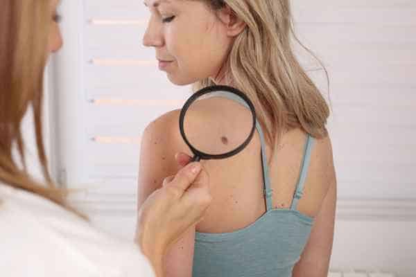 What Are Traditional Skin Lesion Removal Methods Barnet?