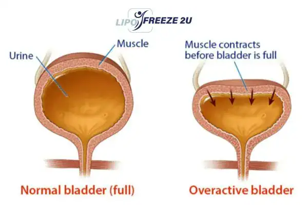 diagram of overactive bladder treatment Barnet