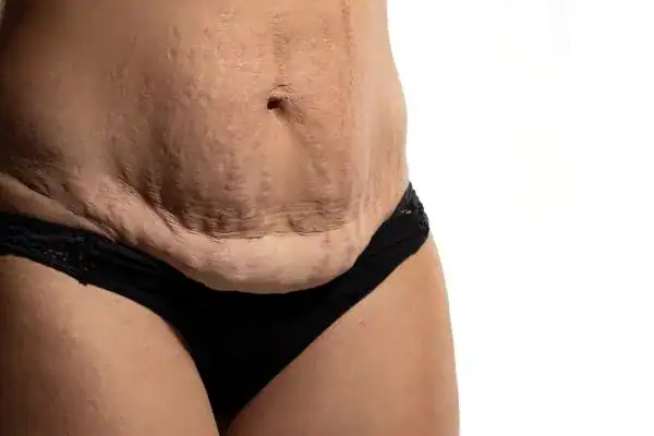 loose skin after weight loss injections Barnet
