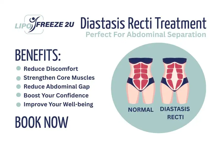 Benefits of body toning treatment Barnet for Diastasis recti