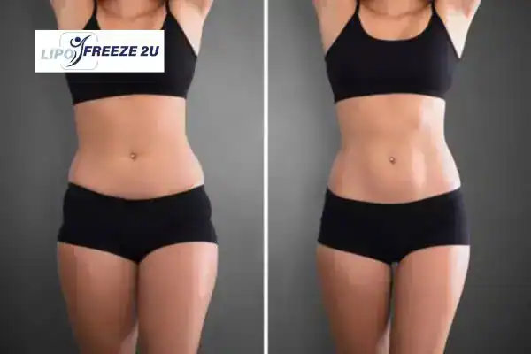 How Can LIPO FREEZE 2U Support Your Post-Pregnancy Body Recovery Barnet?