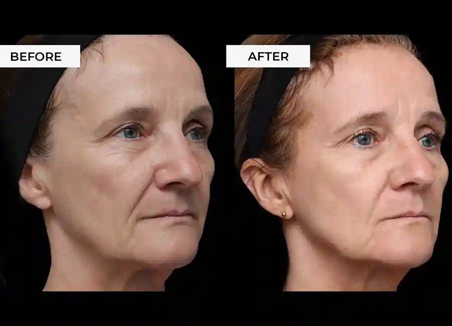 How Many RF Microneedling Sessions Will You Need to See a Difference Barnet?
