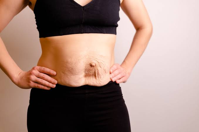 Is Surgery Really the Only Way to Repair Diastasis Recti Barnet?