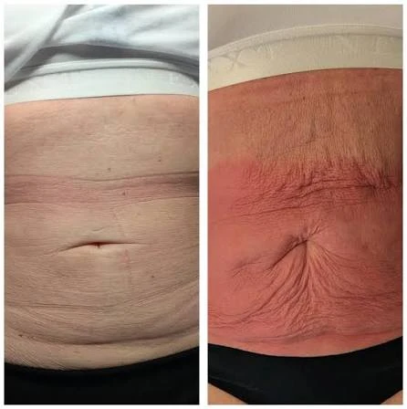 How Does RF Microneedling Improve Crepey, Thin and Uneven Skin Texture Barnet?