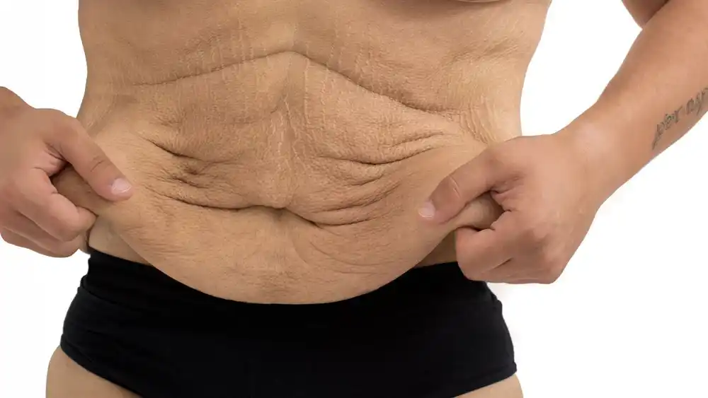 Why Does Weight Loss Medication Leave Some People With Loose or Sagging Skin Barnet?